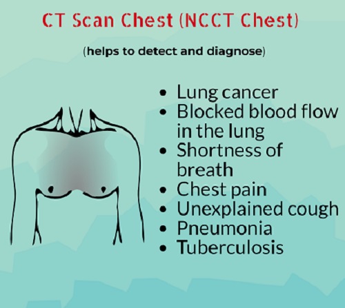 Chest CT Scan & CT Scan Contrast Chest Cost in Noida 